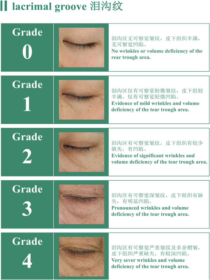 中國女性淚溝紋分級標(biāo)準(zhǔn)-上海市皮膚病醫(yī)院
