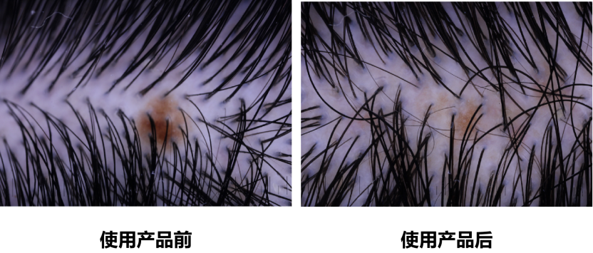 頭皮健康,紅斑,,丘疹,膿皰,評價方法